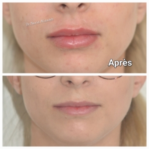 injection acide hyaluronique des lèvres injection acide hyaluronique des lèvres