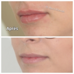 injection acide hyaluronique des lèvres