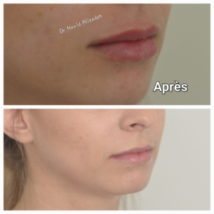 injection acide hyaluronique des lèvres