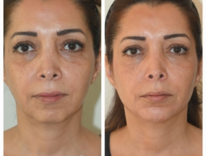 Traitement de l'oval du visage avec acide hyaluronique