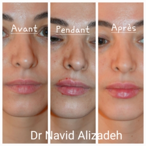 Injection acide hyaluronique des lèvres Injection acide hyaluronique des lèvres