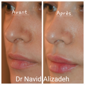 Injection acide hyaluronique des lèvres Injection acide hyaluronique des lèvres