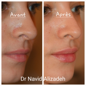 Injection acide hyaluronique des lèvres Injection acide hyaluronique des lèvres