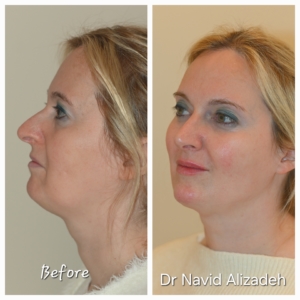 Embellissement du menton et nez par Injection acide hyaluronique